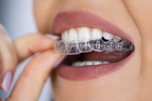A clear dental aligner positioned in a curved shape, showcasing its transparent design and tooth-matching contours